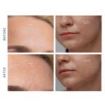 Foreo KIWI Derma Diamond Mikrodermabrazyon Vakumlu Siyah Nokta Temizleme Cihazı - Görsel 4
